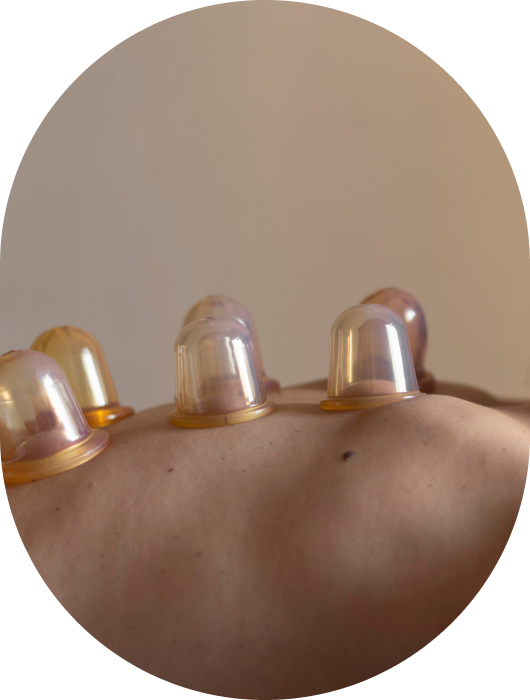 body massages, cupping therapy, cupping services, cupping massage